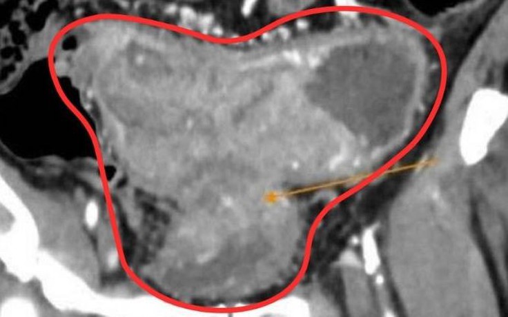 Từ chối mổ, tự ý dùng thuốc nam, bệnh nhân ung thư chuyển nặng