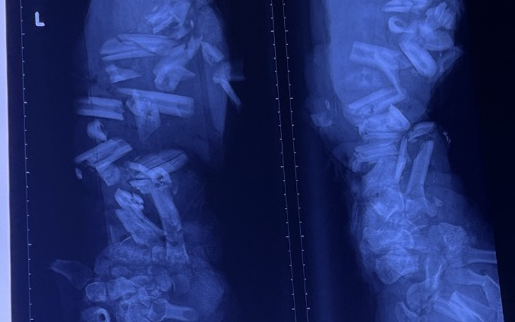 Ca tai nạn lao động thương tâm: Cánh tay bị máy nghiền vỏ dừa cán nát