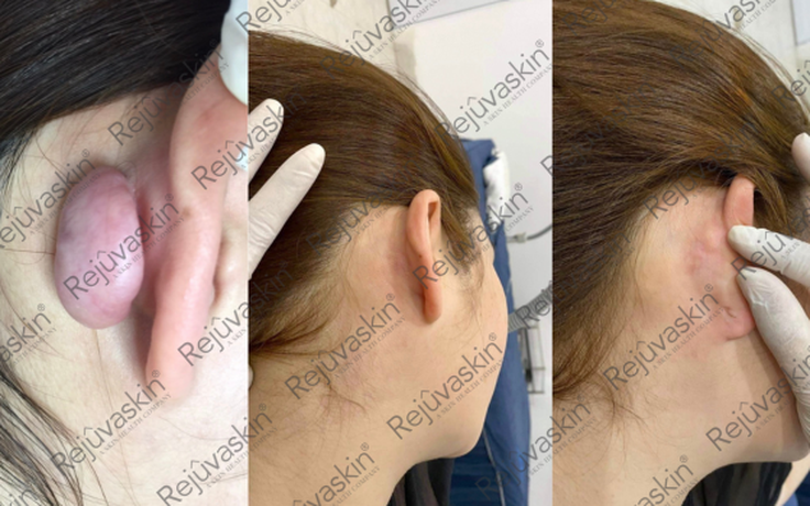 Nâng cấp hiệu quả điều trị sẹo lồi với lời khuyên từ chuyên gia da liễu