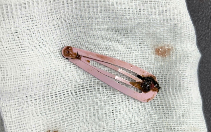 Nuốt kẹp tóc dài 7 cm trong lúc ngủ trưa, bé gái 6 tuổi phải nhập viện