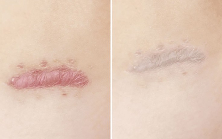 Những điều bạn cần biết trước khi chăm sóc sẹo lồi/phì đại