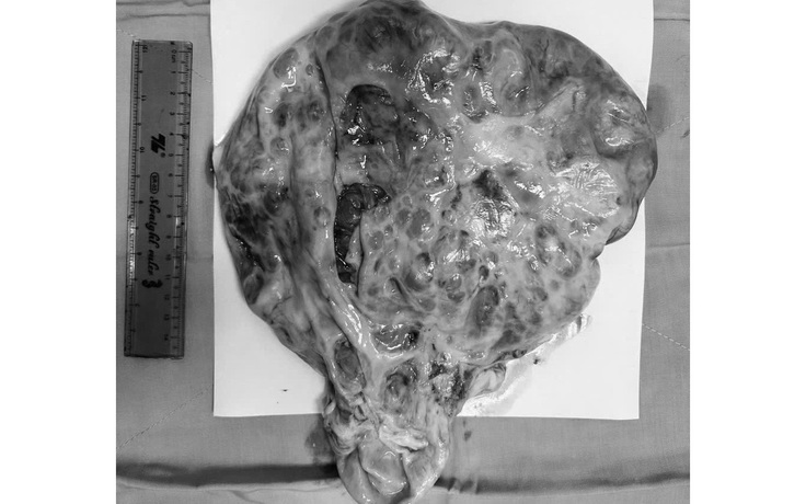 Mổ nội soi lấy khối u nặng hơn 6 kg cho nữ bệnh nhân ở Vĩnh Long