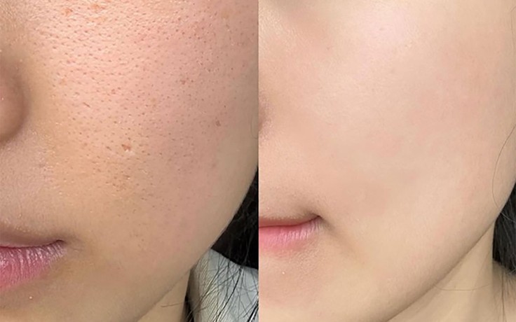 Cẩm nang chăm sóc da sẹo rỗ phục hồi phẳng mịn sau laser bóc tách