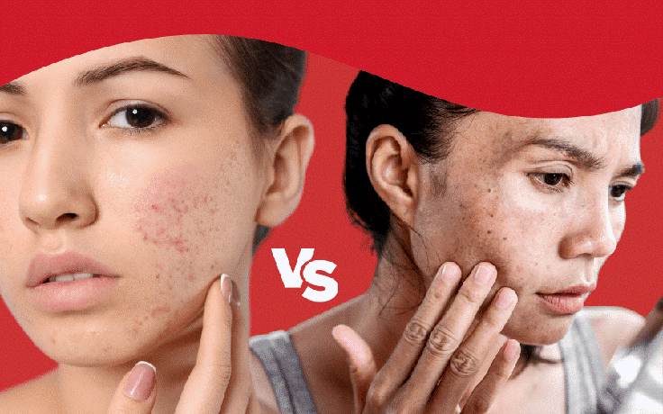 Hết thâm đỏ sau mụn nhanh: Cách chọn sản phẩm chuẩn khoa học