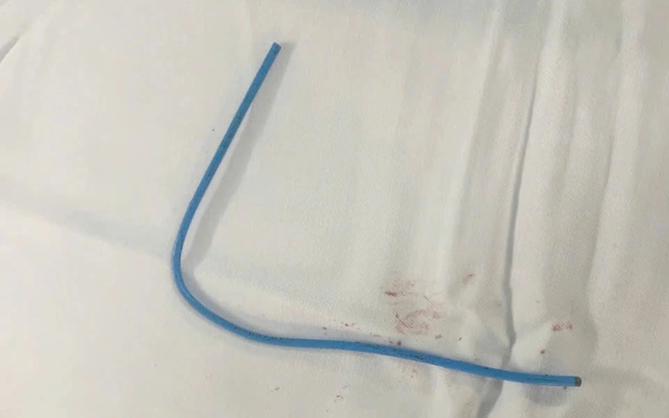 Bệnh viện Quân y 175 tiếp nhận ca bệnh bị dị vật kẹt trong tim hiếm gặp