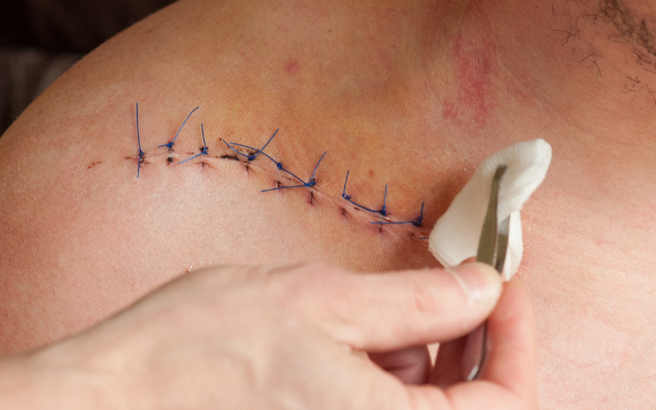 Chuyên gia chia sẻ cách chăm sóc vết mổ sau phẫu thuật phục hồi nhanh, ngừa sẹo