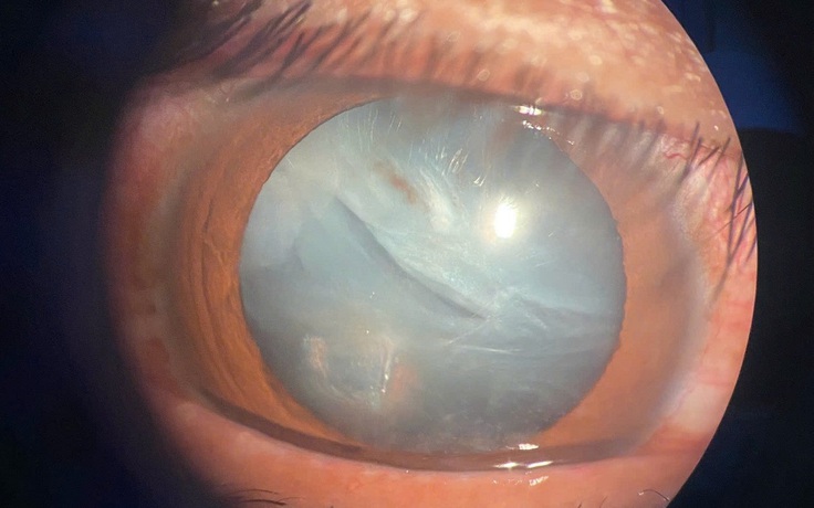 Nam thanh niên bị dây kẽm bắn vào mắt gây rách nhãn cầu