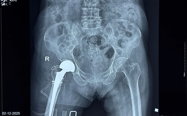 Thay khớp háng thành công cho cụ bà 100 tuổi