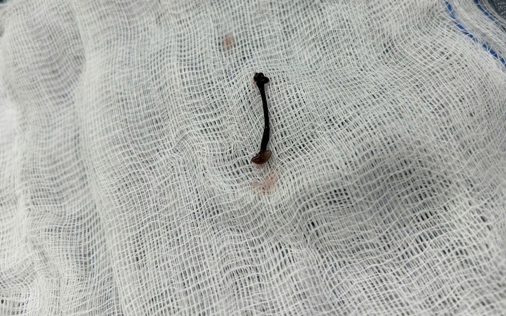 Tắm suối, bé trai 30 tháng tuổi bị vắt chui vào mũi