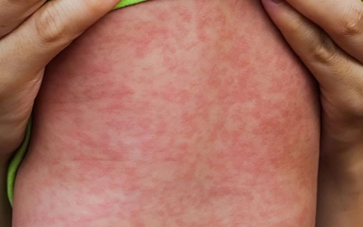 Cảnh báo nhóm nguy cơ cao bị biến chứng nặng do sởi