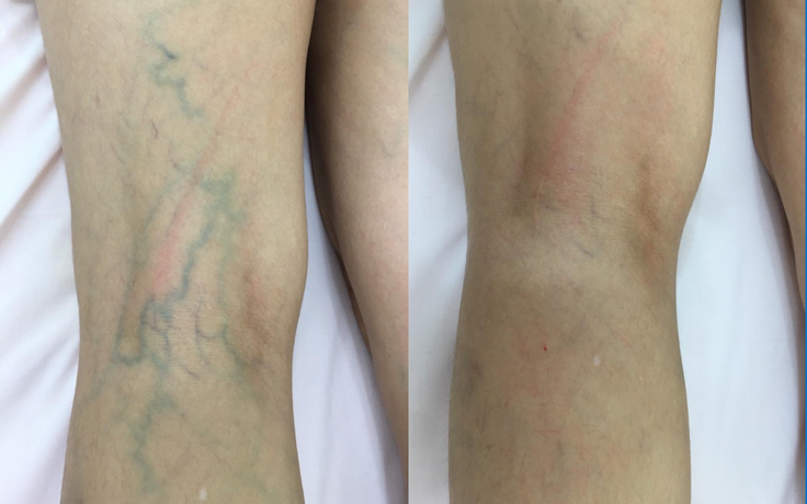Vì sao nhân viên y tế dễ bị suy giãn tĩnh mạch chân?