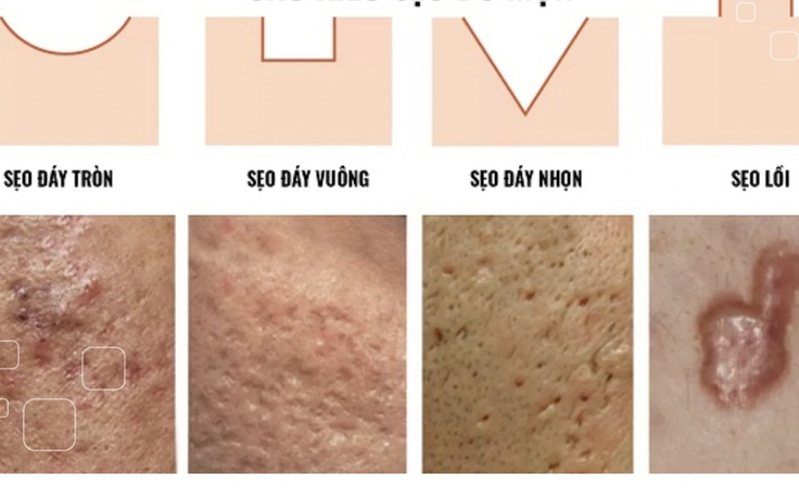 Scar Esthetique: Công nghệ trị sẹo tiên tiến chuẩn y khoa