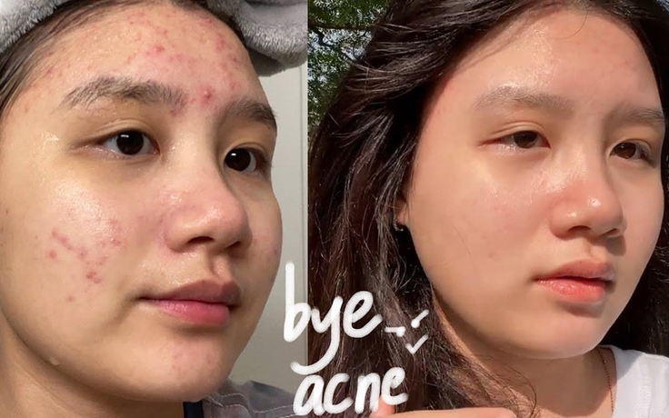 Top 12 kem trị mụn cho da dầu được gen Z, gen Alpha tìm mua nhiều Top 12 kem trị mụn cho da dầu được gen Z, gen Alpha tìm mua nhiều