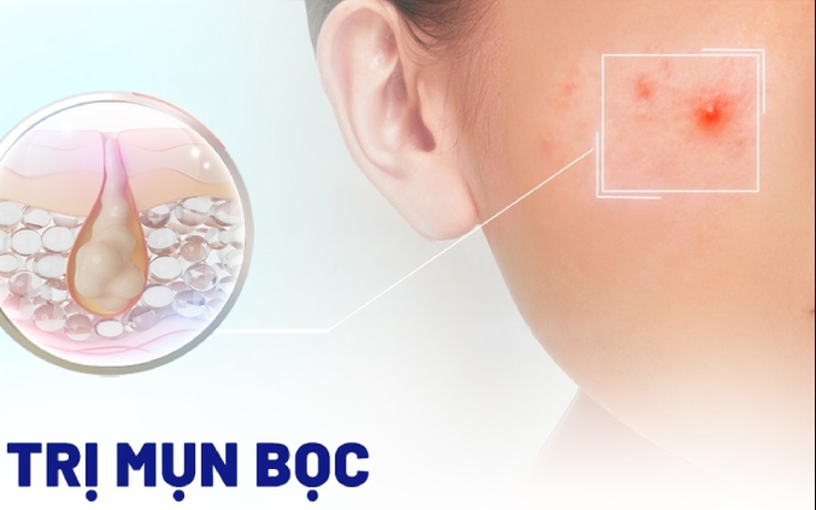 Top 10 kem trị mụn bọc 'cứu tinh' cho da dầu hết sưng, hết đau, không thâm Top 10 kem trị mụn bọc 'cứu tinh' cho da dầu hết sưng, hết đau, không thâm