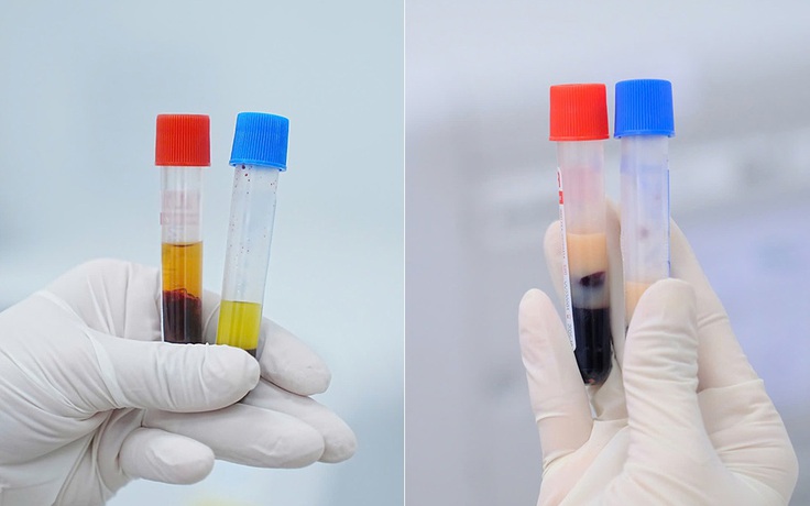 Đi khám thấy huyết thanh đục như sữa, dấu hiệu cảnh báo nguy cơ đột quỵ