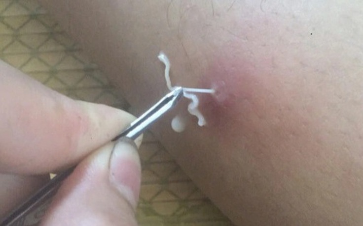 Nhiễm giun rồng do đâu, nguy hiểm không?