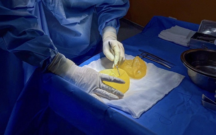 Biến chứng nâng ngực là gì?