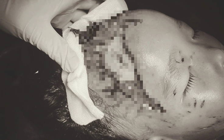 Bé trai 2 tuổi bị chó cắn lộ xương sọ khi sang nhà người thân chơi