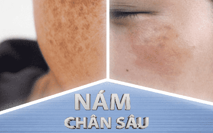 Top 6 kem trị nám chân sâu hiệu quả tại nhà, ngừa tái phát, không bong tróc