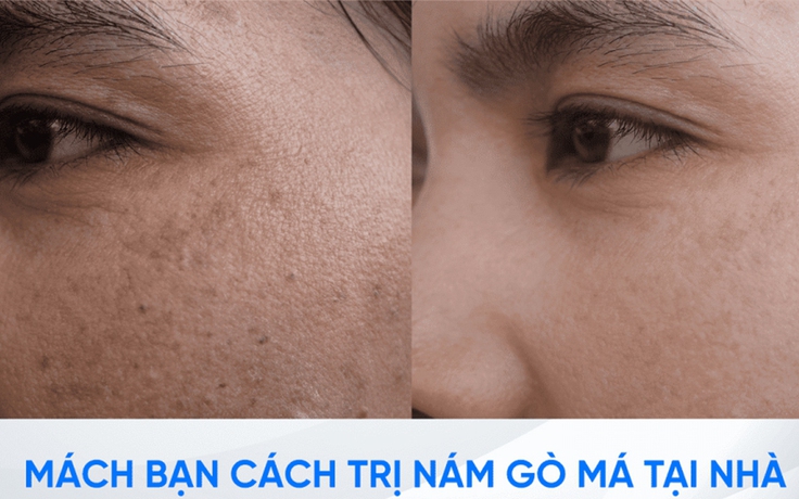 Làm thế nào để trị nám gò má dứt điểm ngay tại nhà, không xâm lấn?