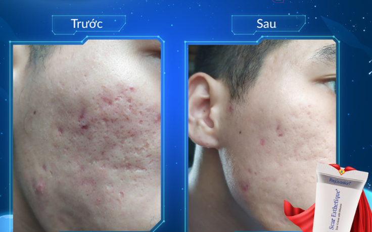 Kiến trúc làn da: ‘vật liệu’ nào giúp tái xây nền da, lấp đầy sẹo lõm?