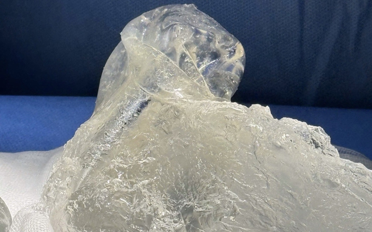 Tháo túi ngực không đau