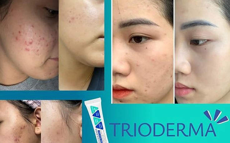 Top 4 kem trị mụn giá rẻ mà hiệu quả với cả mụn thể nặng