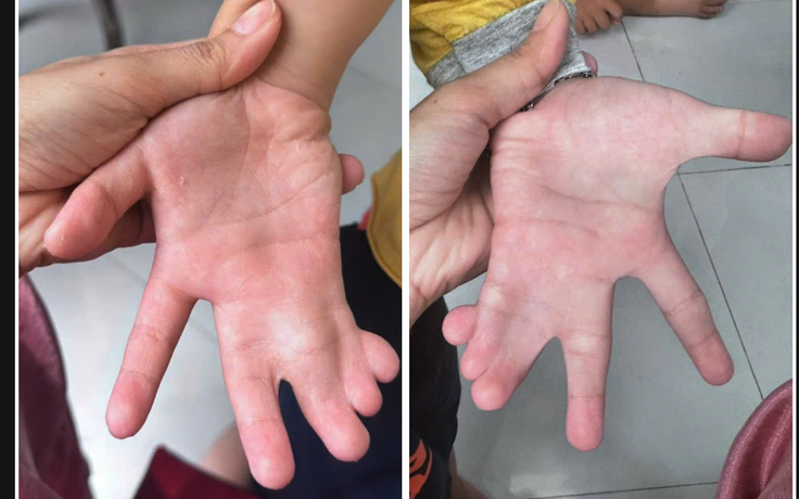 TP.HCM: Phẫu thuật tách bàn tay dính ngón cho bé trai 6 tuổi
