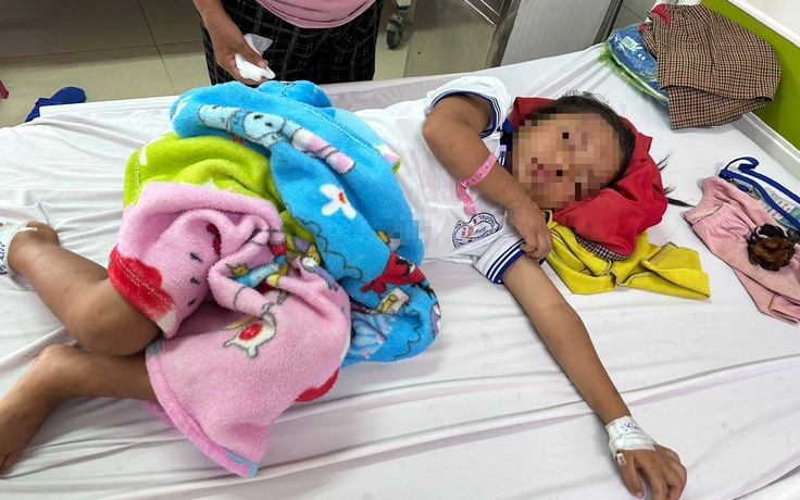 Bé 7 tuổi bị ong đốt 200 vết gây tổn thương mắt