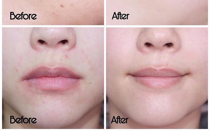 Top 5 kem dưỡng phục hồi sau trị mụn ai cũng 'mê' ngay lần đầu tiên