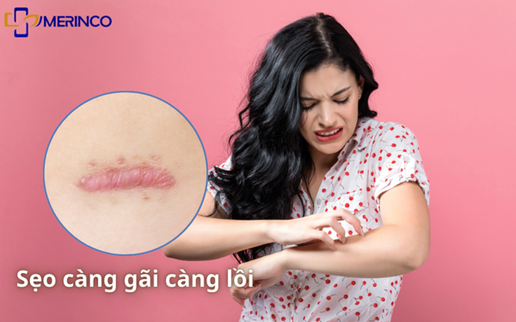 Sẹo lồi hay ngứa do đâu? Có trị hết được không?