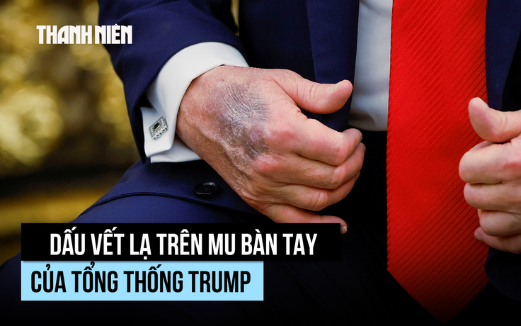 Vết bầm lạ trên mu bàn tay Tổng thống Trump là gì?