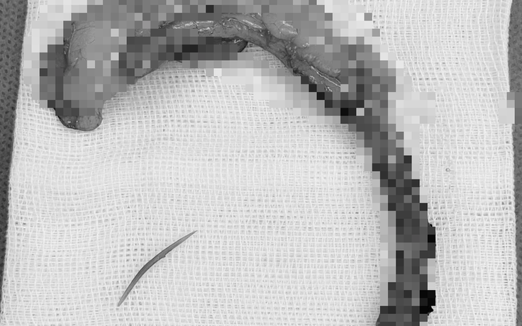 Từ mảnh xương cá 'ẩn mình' đến ca phẫu thuật 3 trong 1 cứu sống cụ ông