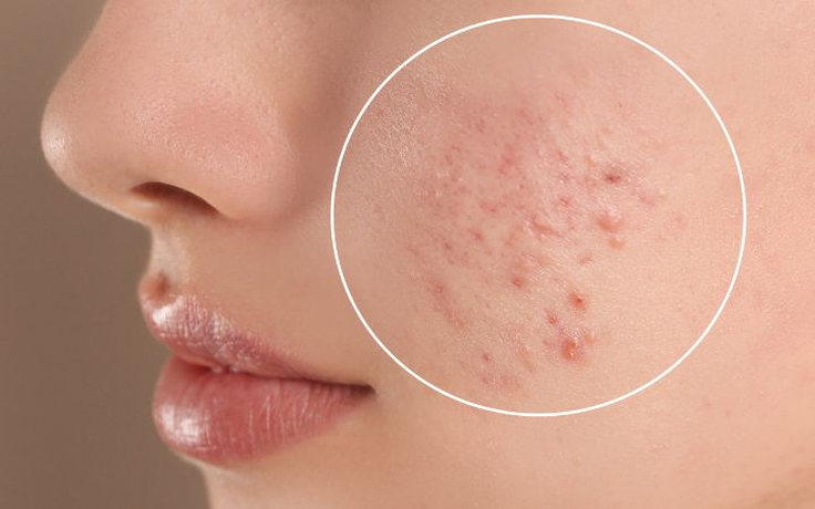 Vì sao da dễ nổi mụn vào giao mùa?