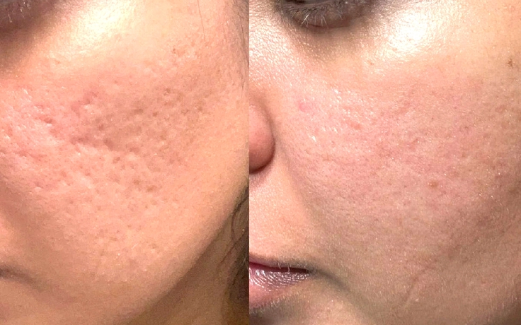 Nguyên tắc vàng trong chăm sóc sẹo: Điều mà nhiều người Việt đang bỏ qua