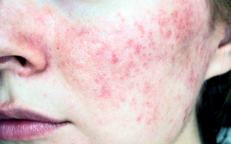 Mùa thu giao mùa - thời điểm dễ tổn thương nhất của làn da nhạy cảm