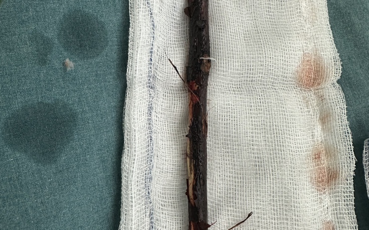 Bé gái 3 tuổi mang cành cây dài 16 cm trong bụng suốt 4 tháng