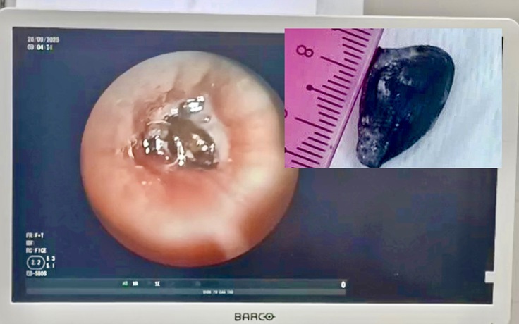 Ho dai dẳng 10 năm vì hạt sapôchê kẹt trong phế quản