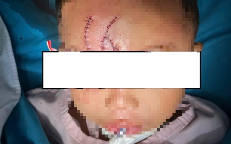 Cứu bé trai 5 tuổi bị chó béc giê cắn xé biến dạng khuôn mặt