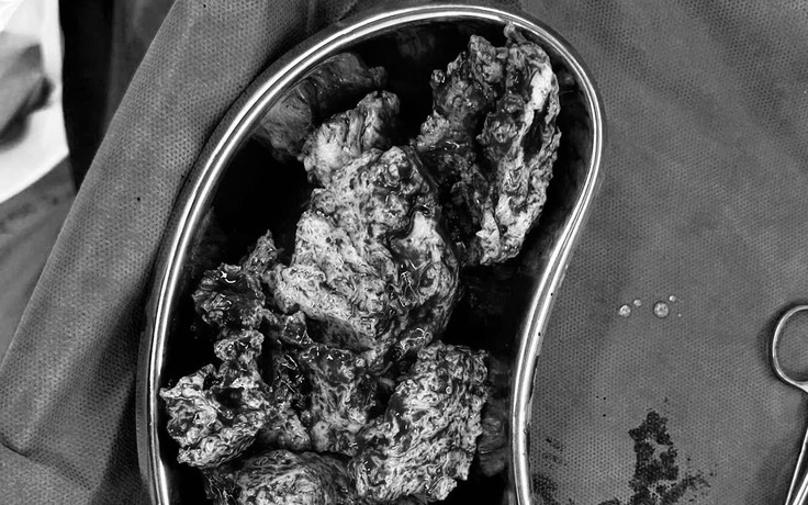 Giữ tử cung thành công sau ca mổ lạc nội mạc tử cung  tại Phương Nam