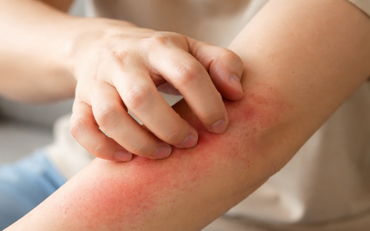 Bị ngứa kéo dài, khi nào là dấu hiệu cảnh báo ung thư?