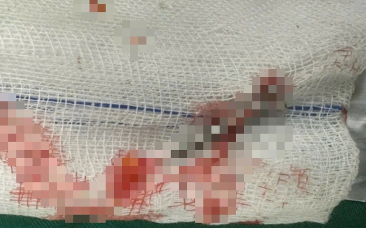 Nam thanh niên bị súng bắn đinh bắn thủng ruột non