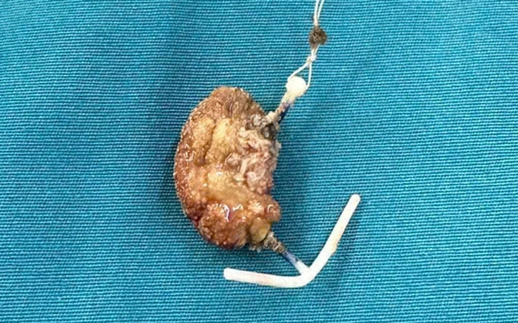 Vòng tránh thai 'đi lạc' vào bàng quang nhiều năm