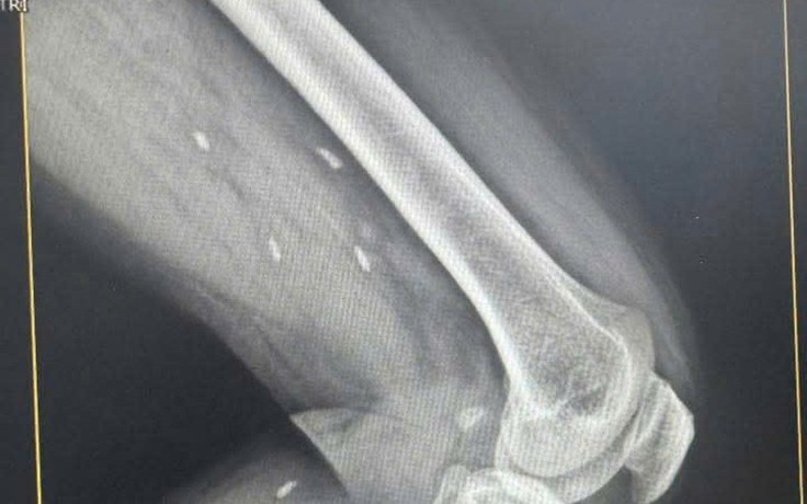 Kén sán rải rác trong vùng đùi và cẳng chân bệnh nhân