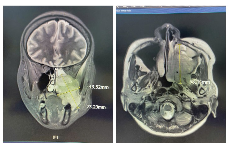 Đau hàm, nghẹt mũi, chảy máu răng - Đi khám phát hiện ung thư xoang