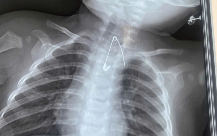 2 trẻ nguy kịch vì nuốt dị vật