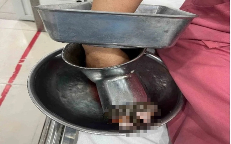 Bị máy xay thịt 'nuốt' bàn tay, người phụ nữ ở TP.HCM phải cắt cụt 3 ngón