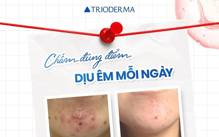 Mụn viêm sưng đỏ: Chấm gì vừa giúp xẹp mụn sau khoảng 1 đêm vừa ngừa sẹo?