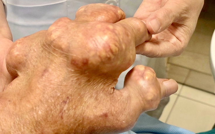 Người bị gout có nên ăn ức gà thay thế hoàn toàn thịt lợn, bò?