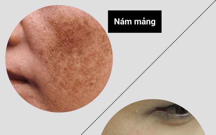 +3 kem mờ nám chân sâu sau khoảng 4 tuần khiến chị em không tin vào mắt